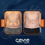 Vorher-nachher-Ergebnisse Bauchdeckenstraffung und Fettabsaugung bei Adem and Havva Medical Center