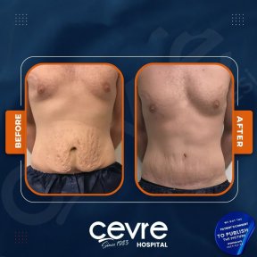 Vorher-nachher-Ergebnisse Bauchdeckenstraffung und Fettabsaugung bei Adem and Havva Medical Center