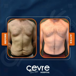 Vorher-nachher-Ergebnisse Bauchdeckenstraffung und Fettabsaugung bei Adem and Havva Medical Center