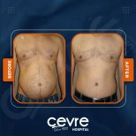 Vorher-nachher-Ergebnisse von Bauchdeckenstraffung und Fettabsaugung bei Adem and Havva