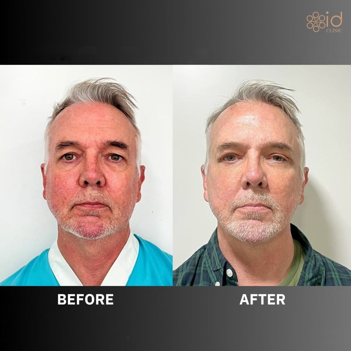Resultados de lifting de cejas antes y después en ID Clinic Bangkok, mejora visible en frente y ojos