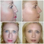 Efekty przed i po plastyce nosa w ID Clinic Bangkok, naturalny wygląd nosa