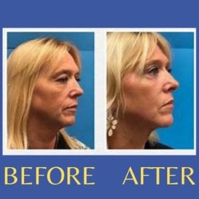 Before and after endoscopic facelift results at ID Clinic Bangkok, visible facial rejuvenation