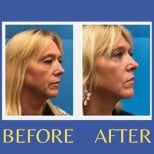 Before and after endoscopic facelift results at ID Clinic Bangkok, visible facial rejuvenation