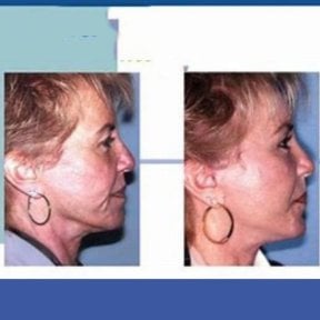 Before and after endoscopic facelift results at ID Clinic Bangkok, visible facial rejuvenation