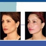 Before and after endoscopic facelift results at ID Clinic Bangkok, facial rejuvenation visible
