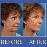 Before and after endoscopic facelift results at ID Clinic Bangkok, facial rejuvenation visible