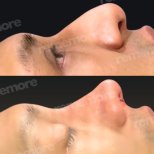 Vorher-nachher-Rhinoplastik-Ergebnisse im Memorial Göztepe Hospital, verbesserte Nasenform