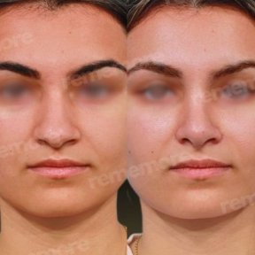 Vorher-nachher-Rhinoplastik-Ergebnis bei Memorial Göztepe Hospital, Nasenkorrektur