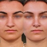 Vorher-nachher-Rhinoplastik-Ergebnis bei Memorial Göztepe Hospital, Nasenkorrektur
