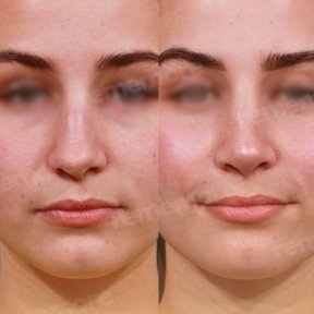 Vorher-nachher-Rhinoplastik-Ergebnisse im Memorial Göztepe Hospital, verbesserte Nasenform