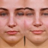 Vorher-nachher-Rhinoplastik-Ergebnisse im Memorial Göztepe Hospital, verbesserte Nasenform