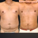 Liposuktion Vorher-Nachher-Ergebnis bei Memorial Göztepe Hospital, verbesserte Bauchkontur