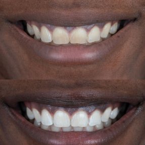 Vorher-nachher-Ergebnis der Zahnreinigung bei Adem and Havva Medical Center, weißeres Lächeln