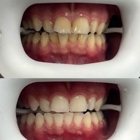 Vorher-nachher-Ergebnis Zahnreinigung (Scaling) bei Adem and Havva Medical Center