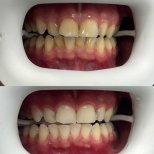 Vorher-nachher-Ergebnis Zahnreinigung (Scaling) bei Adem and Havva Medical Center