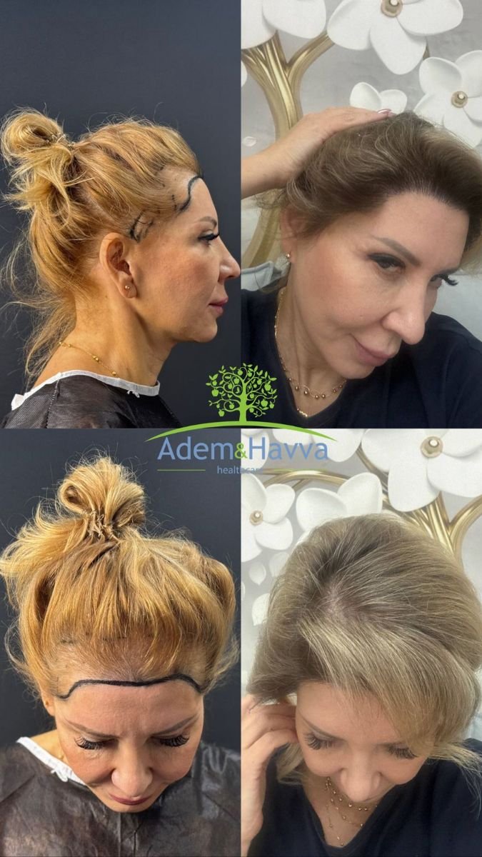 نتائج زراعة الشعر للنساء قبل وبعد في مركز آدم وحواء الطبي، خط شعر أكثر كثافة