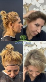 Vorher-nachher-Ergebnisse der Haartransplantation für Frauen bei Adem and Havva, vollere Haarlinie