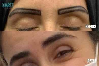 نتائج زراعة الحواجب قبل وبعد في Quartz Hospital، استعادة طبيعية للحواجب