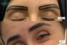 نتائج زراعة الحواجب قبل وبعد في Quartz Hospital، استعادة طبيعية للحواجب