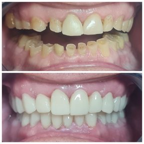 Vorher-nachher-Ergebnis Zirkonkrone bei SoftDentalCare Clinic, Lächeln restauriert