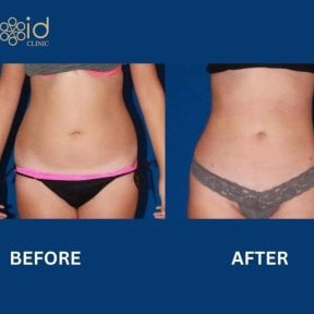 Before and after 360 liposuction results at ID Clinic Bangkok, visible waist contour improvement