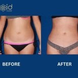 Before and after 360 liposuction results at ID Clinic Bangkok, visible waist contour improvement