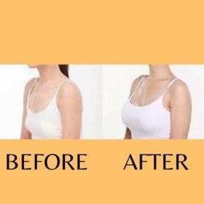 Before and after breast augmentation results at ID Clinic Bangkok, enhanced breast volume