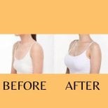 Before and after breast augmentation results at ID Clinic Bangkok, enhanced breast volume