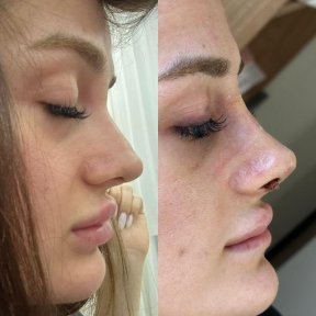 Vorher-nachher-Rhinoplastik-Ergebnisse bei Memorial Göztepe Hospital, Nasenkorrektur