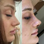 Vorher-nachher-Rhinoplastik-Ergebnisse bei Memorial Göztepe Hospital, Nasenkorrektur