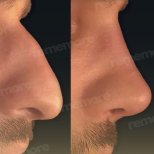 Vorher-nachher-Ergebnis der Revision-Rhinoplastik im Memorial Göztepe Hospital, verbesserte Nasenform