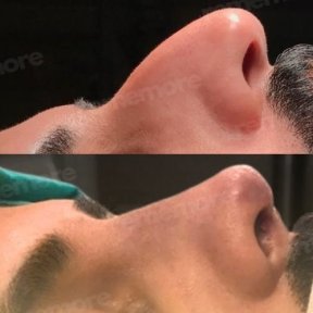 Vorher-nachher-Ergebnis der Revision-Rhinoplastik im Memorial Göztepe Hospital, verbesserte Nasenform
