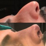 Vorher-nachher-Ergebnis der Revision-Rhinoplastik im Memorial Göztepe Hospital, verbesserte Nasenform