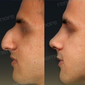 Vorher-nachher-Ergebnis der Revision-Rhinoplastik im Memorial Göztepe Hospital, verbesserte Nase