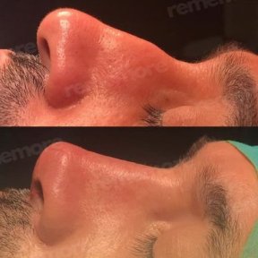 Vorher-nachher-Ergebnis der Revision-Rhinoplastik in Memorial Göztepe Hospital, verbesserte Nasenform