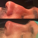 Vorher-nachher-Ergebnis der Revision-Rhinoplastik in Memorial Göztepe Hospital, verbesserte Nasenform