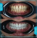 Vorher-nachher-Ergebnis Zahnreinigung (Scaling) bei Adem and Havva Medical Center