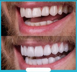 Vorher-nachher-Ergebnis Zahnreinigung (Scaling) bei Adem and Havva Medical Center