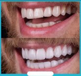 Vorher-nachher-Ergebnis Zahnreinigung (Scaling) bei Adem and Havva Medical Center