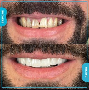Vorher-nachher-Ergebnis Zahnreinigung bei Adem and Havva Medical Center, strahlendes Lächeln