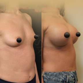 Vorher-nachher-Ergebnis Brustvergrößerung mit Eigenfett in der Dr. Safa Manav Klinik