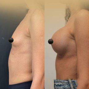 Vorher-nachher-Ergebnis Brustvergrößerung mit Eigenfett in der Dr. Safa Manav Klinik