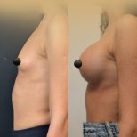 Vorher-nachher-Ergebnis Brustvergrößerung mit Eigenfett in der Dr. Safa Manav Klinik