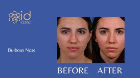 Foto sebelum dan sesudah Rinoplasti oleh Dr. 