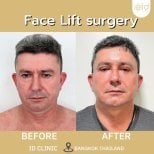 Before and after facelift results at ID Clinic Bangkok, visible facial rejuvenation outcome