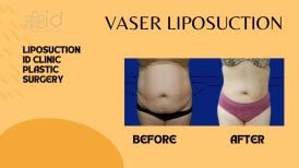 Fotos de antes y después de Liposucción Vaser tomadas por el Dr.(la Dra.) 