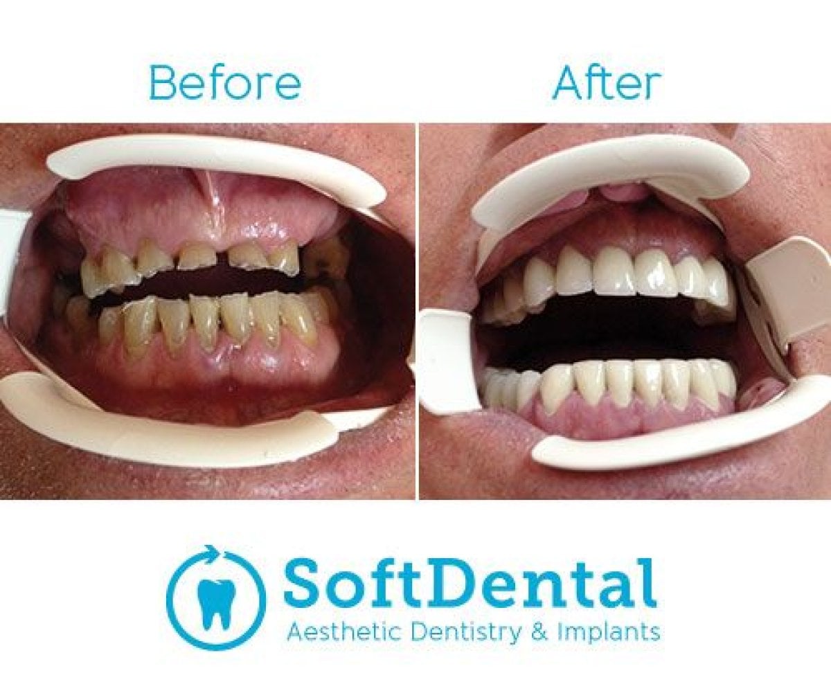 نتائج قبل وبعد جسر الأسنان الزركوني في SoftDentalCare Clinic، استعادة الابتسامة