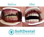 Vorher-nachher-Ergebnis Zirkon-Brücke bei SoftDentalCare Clinic, Lächeln wiederhergestellt