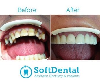 Vorher-nachher-Ergebnis Zirkon-Brücke bei SoftDentalCare Clinic, Lächeln wiederhergestellt